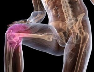 artroza deformantă a tratamentului simptomelor articulației genunchiului boala de coxartroză de gradul 2